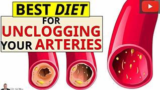 [d5371] *Full* *Download* Best Diet For Removing Calcium Deposits & Plaque Buildup From Your Arteries - Dr Sam Robbins ~PDF~